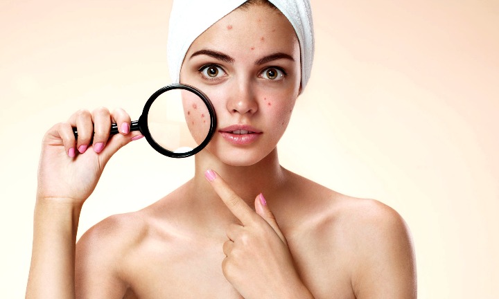 Mitos y verdades sobre el acné